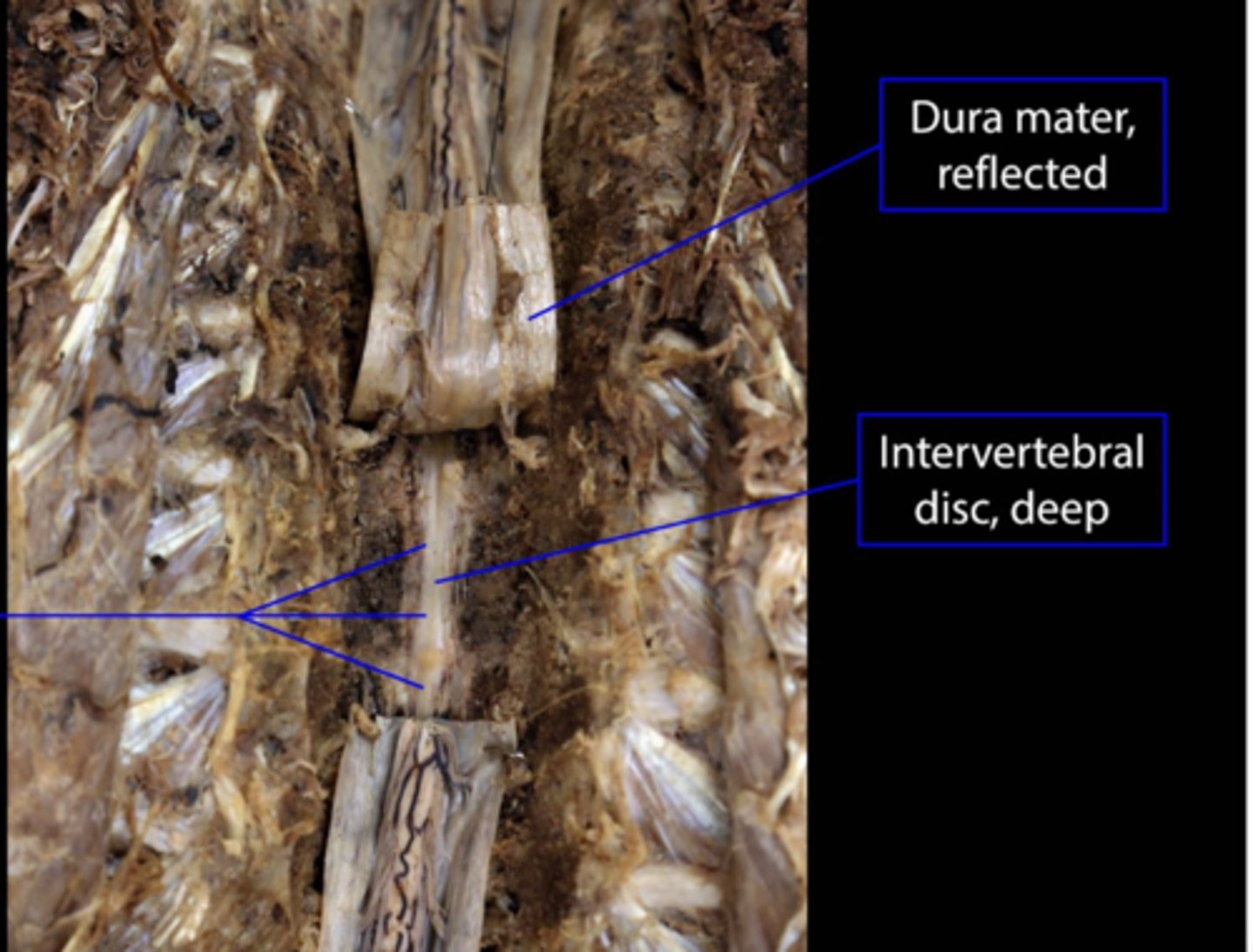 <p>tough outer layer of the meninges</p>