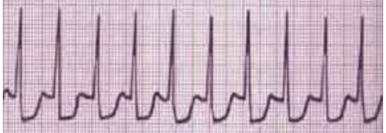 <p>Paroxysmal supraventricular tachycardia is defined by its __ QRS complexes with no apparent __ wave. </p>