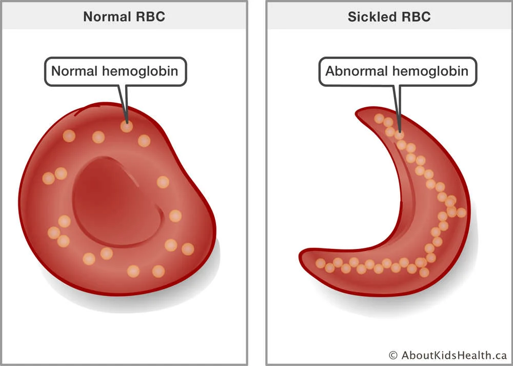 <p>Sickle cell disease. This occurs because of a single base mutation, and leads to haemoglobin having the wrong shape, which means that red blood cells have a curved shape, can’t carry oxygen as well and aren’t flexible anymore. This causes blood to clot and blocks blood flow</p>