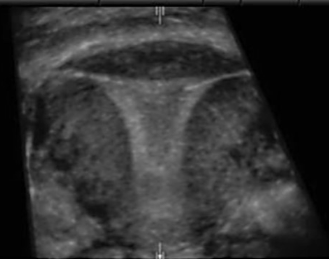 <p>a) 3D of abn mirena IUD placement</p><p>b) 2D of normal Essure microinserts</p><p>c) 3D of normal Mirena IUD placement</p><p>d) 3D of normal Essure microinserts</p>