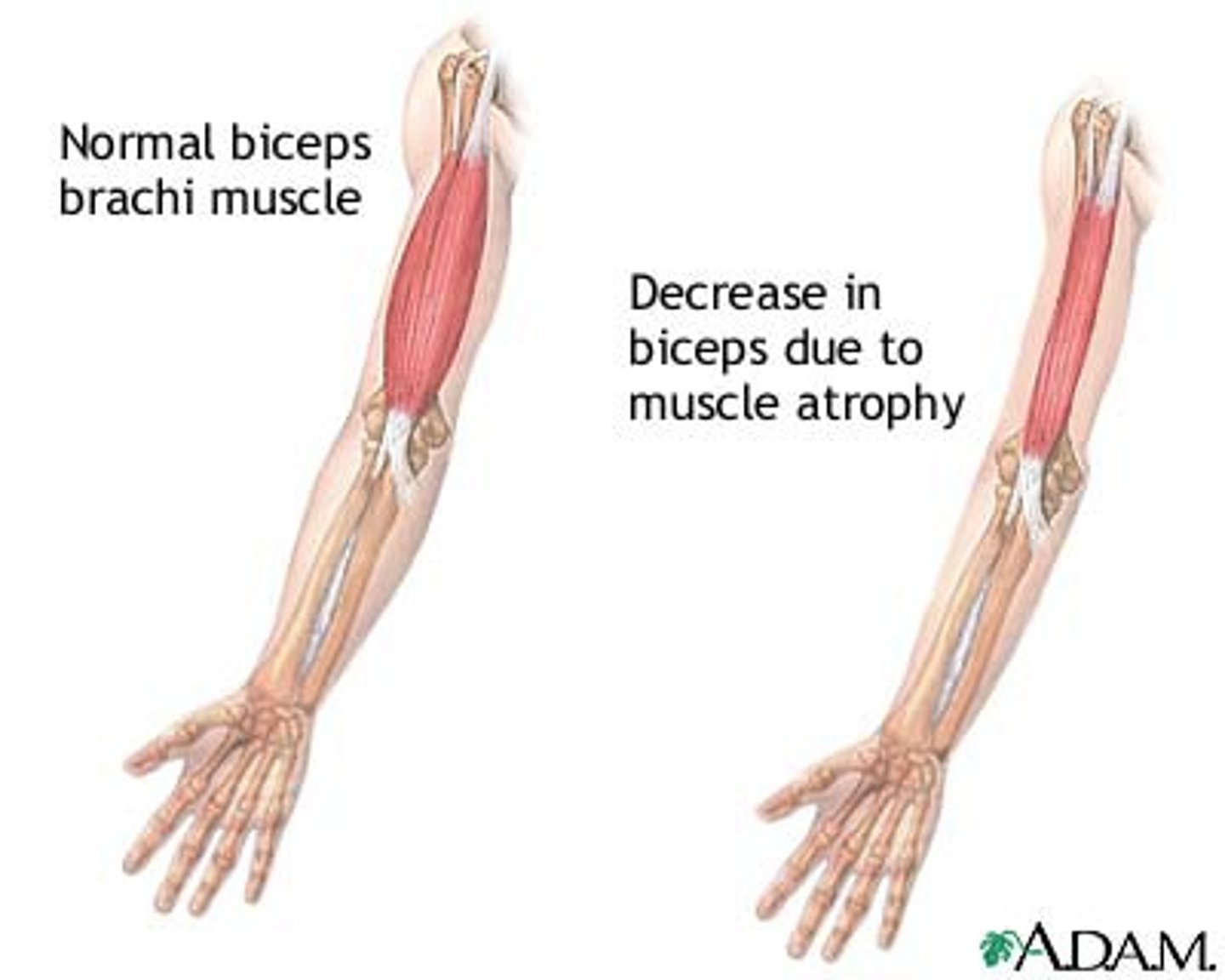 <p>means when muscles or body parts become weak or smaller. This can happen if the muscle is sick or if it is not used for a long time.</p>
