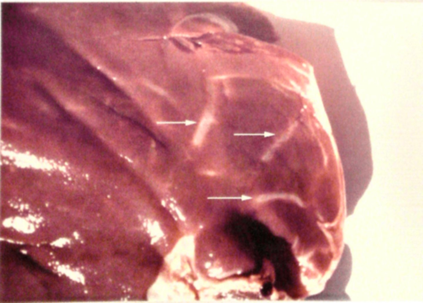 <p>Lever fra får, hvad er den patoanatomiske diagnose og ætiologien?</p>