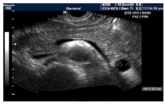 <ul><li><p><span style="background-color: transparent;">Collection of pancreatic enzymes and bodily fluid in cyst, without epithelial lining</span></p><ul><li><p><span style="background-color: transparent;">Formed from pancreas damage → pancreatic fluid leaks → cyst</span></p></li></ul></li><li><p><span style="background-color: transparent;"><u>Most common cystic lesions of the pancreas (75-85% of cases)</u></span></p></li><li><p><span style="background-color: transparent;">Appearance: well-circumscribed, outside pancreas</span></p></li><li><p><span style="background-color: transparent;">Most common symptom: abdominal pain and bloating</span></p></li></ul><p></p>
