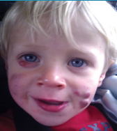 <p><strong>Infantile Acne</strong></p><p>-Presents around __-__ months</p><p>-Uncommon but presents more often in ______</p><p>-Results from hyperplasia of __________ glands, secondary to _________ stimulation</p><p>-Inflammatory papules, pustules, _________, and sometimes nodules (can lead to _________)</p><p>-Typically resolves spontaneously by _ year old </p><p>-Treatment </p><ul><li><p>Mild to Moderate → keratolytic agents (2.5% ______ _______), topical antibiotics (clinda or erythromycin), topical retinoids</p></li><li><p>Severe → oral antibiotics (erythromycin or ________), could also try oral isotretinoin </p></li></ul><p>-Severe, unremitting cases need to be evaluated for CAH, gonadal or adrenal _______, and precocious _________</p><p></p>