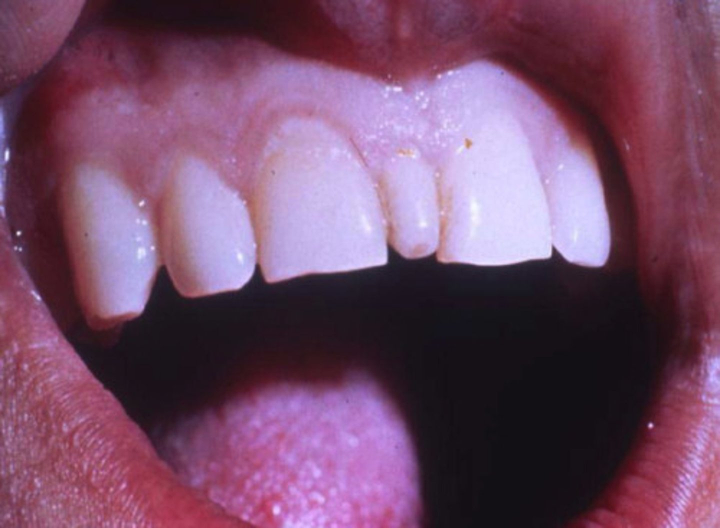 <p>Btwn maxillary centrals</p>