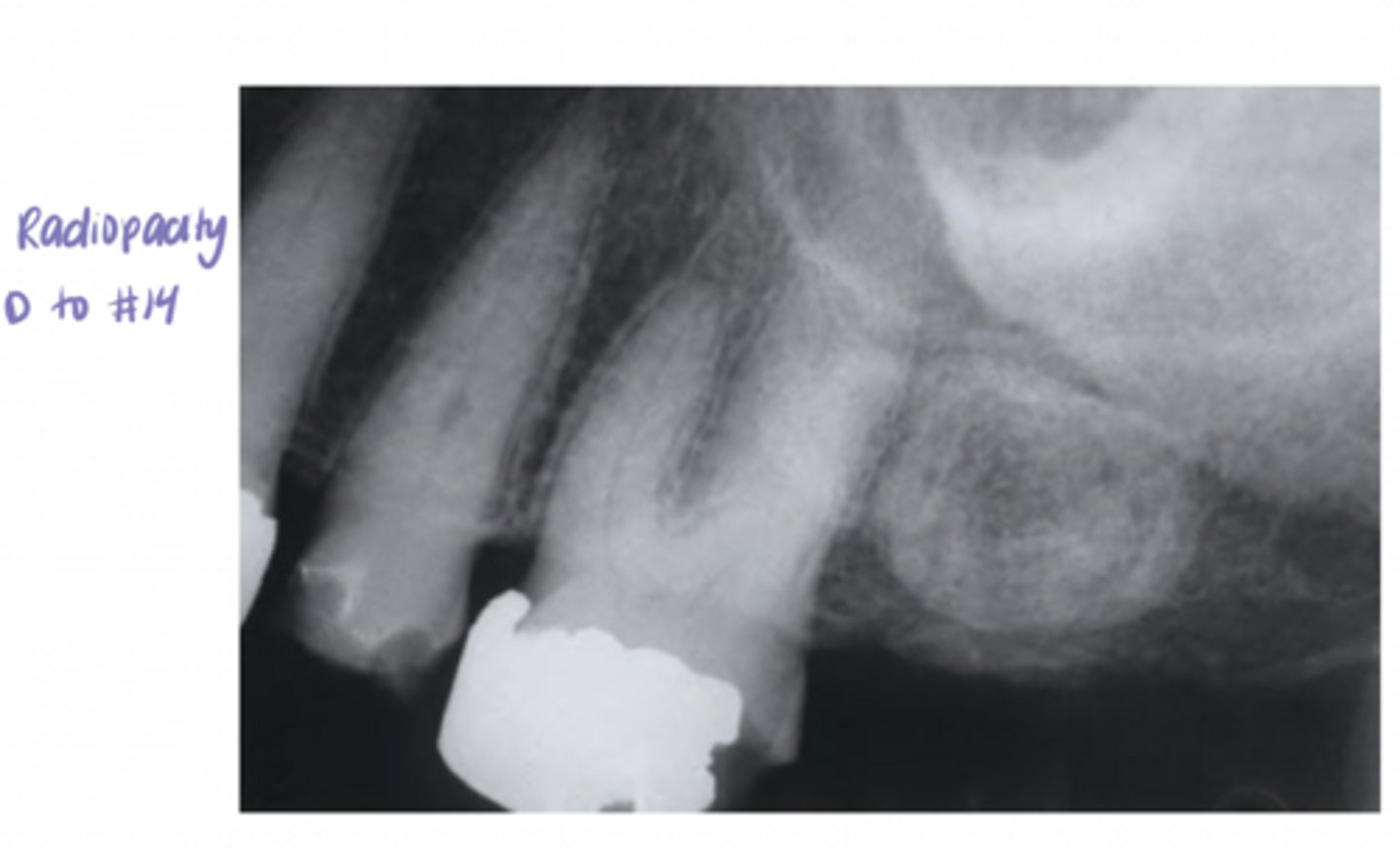 <p>A. exostoses (may be radiopaque)</p>