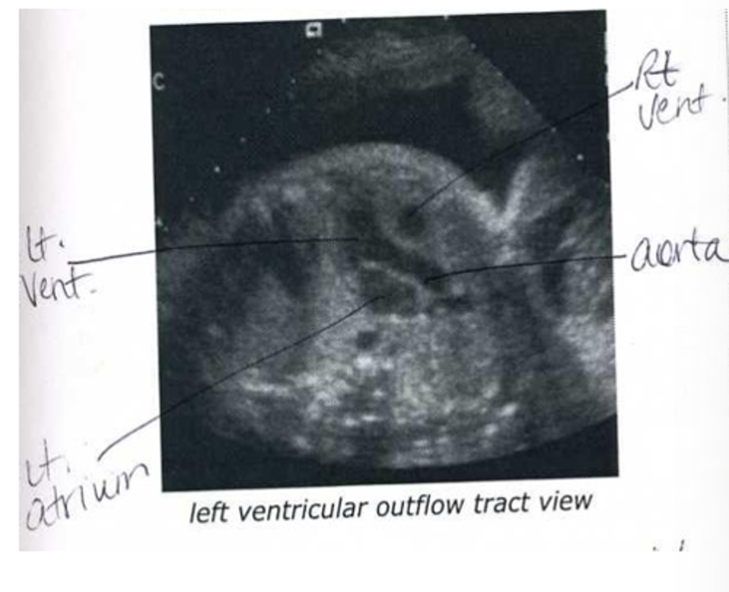 <p>connects left ventricle to aorta</p>