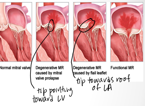 <p>in <strong>prolapse</strong> chordal connections of leaflet to pap muscle are still intact so tip will still point to<strong> LV apex</strong></p><p>in<strong> flail</strong> tip of leaflet will point towards the <strong>roof of the LA </strong>in systole</p>