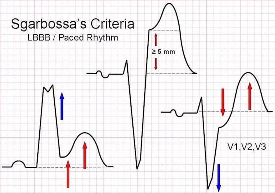 <p>concordant ST elevation of 1mm or more in any lead w/ pos QRS</p><p>concordant ST depression of 1mm or more in V1-V3</p><p>discordant ST elevation of 5mm or more in any lead w/ neg QRS</p>