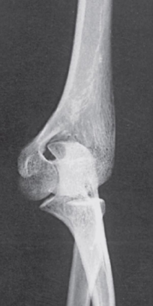 <p>medial epicondyle</p>