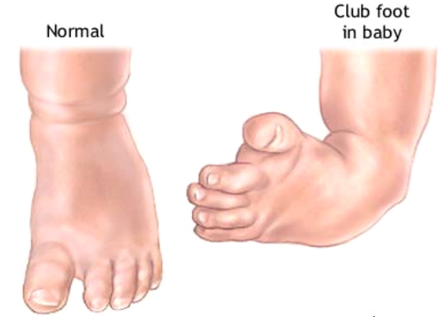 <p>equinovarus</p>