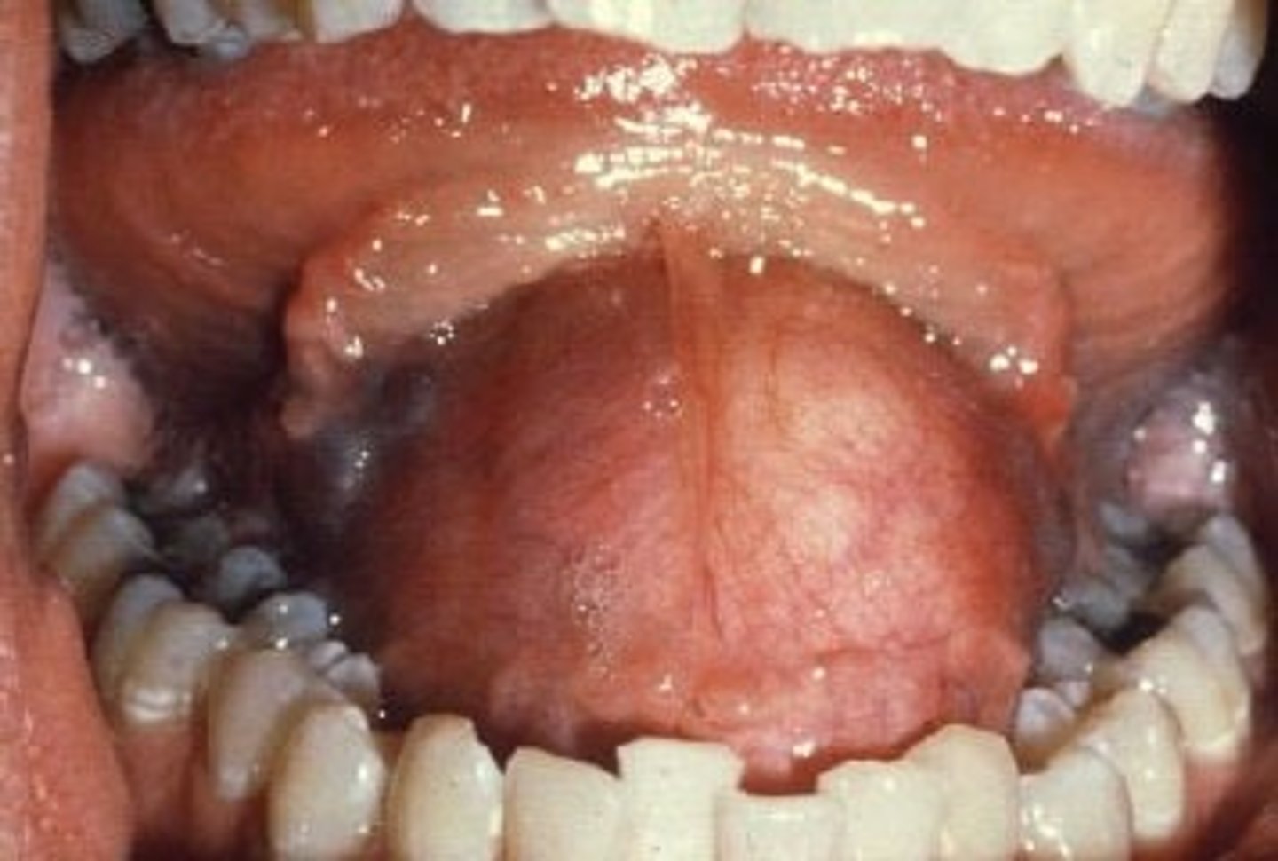 <p>1. anterior floor of mouth</p>
