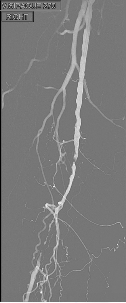 <p>Risks and complications of Angiography (peripheral and coronary)</p>