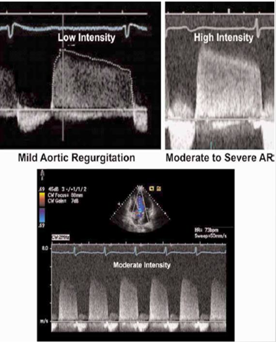 <p>dense signals → greater quantity</p><p>faint signals → mild regurg&nbsp;</p>