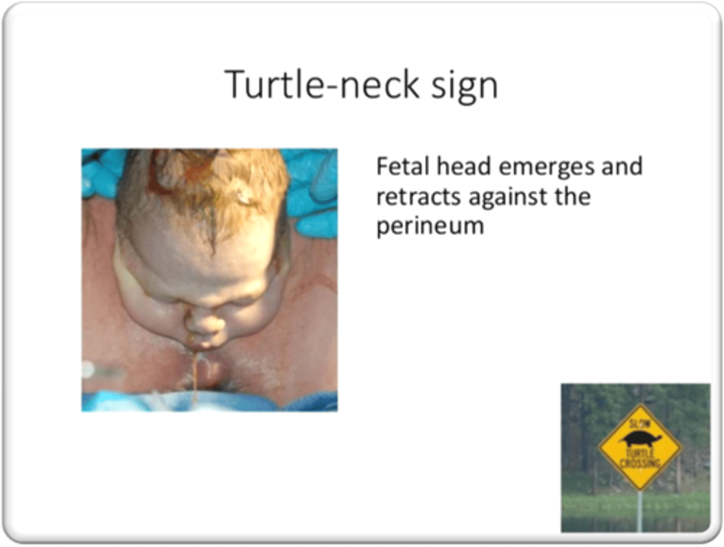 <p>first sign of a shoulder dystocia</p>