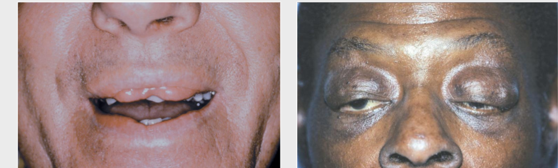 <p><strong>double lip</strong>, blepharochalasis (eyelid edema), and sometimes nontoxic thyroid enlargement </p>