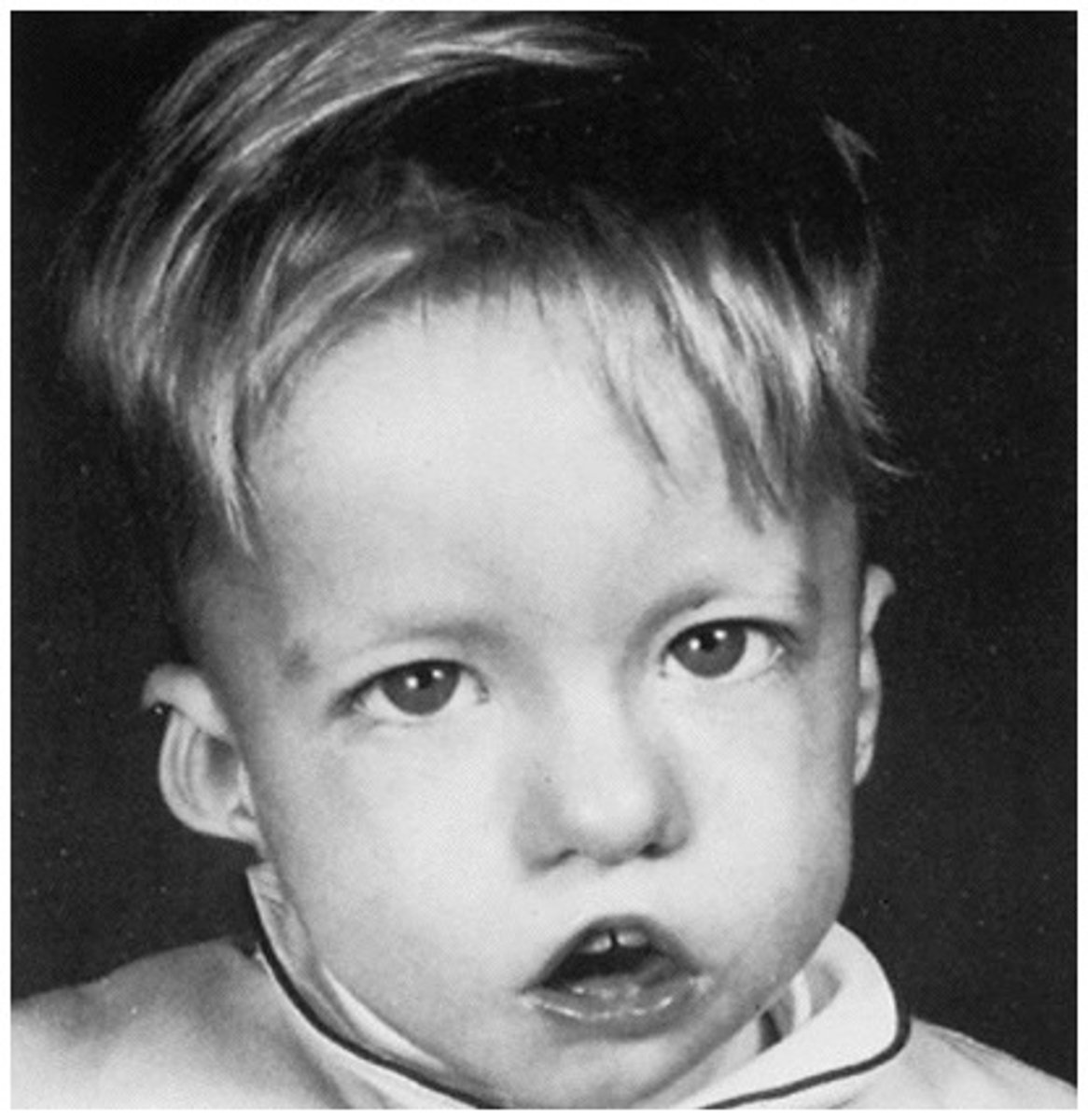 <p>(Shprintzen syndrome) (DiGeorge sequence)</p><p>Most commonly associated with cleft palate</p><p>Autosomal dominant</p><p>Often middle ear infections, learning problems, speech and feeding problems, and unique facial characteristics.</p><p>Usually cleft palate and/or velopharyngeal insufficiencies</p><p>Intelligence usually low-normal range</p><p>Feeding problems and failure to thrive (pharyngeal hypotonia, oral apraxia, laryngeal and vasucalr anomalies, and nasal regurgitation and nasalvomiting)</p>