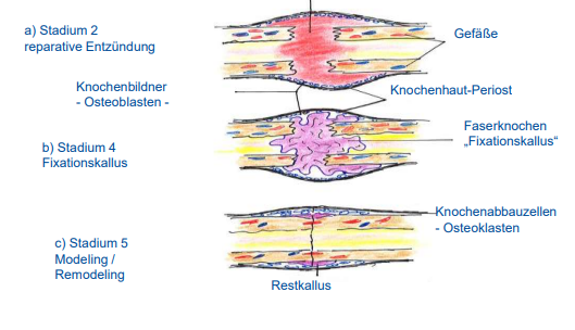 <p>Knochenbruchheilung</p><p><strong>Sekundäre Frakturheilung</strong></p>
