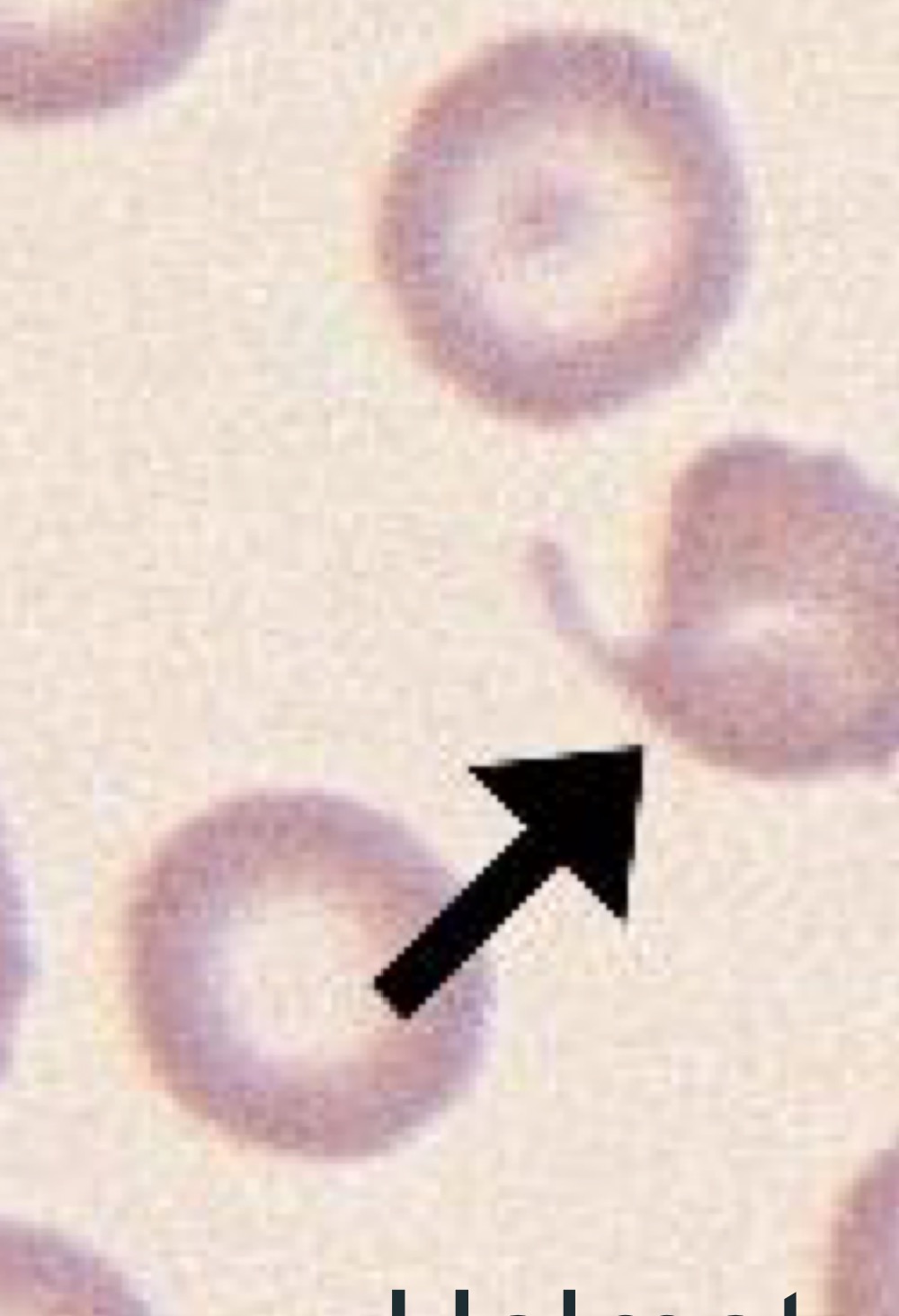 Name this RBC Abnormality.