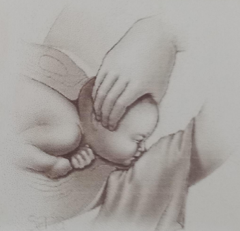 <ul><li><p>done by supporting the perenium with a towel during delivery</p></li><li><p>facilitates complete flexion</p></li><li><p>avoids laceration</p></li><li><p>extracting the fetal head, using one hand to pull the fetal chin from between the maternal anus and the coccyx, and the outer on the fetal occiput to control speed of delivery</p></li></ul><p></p>