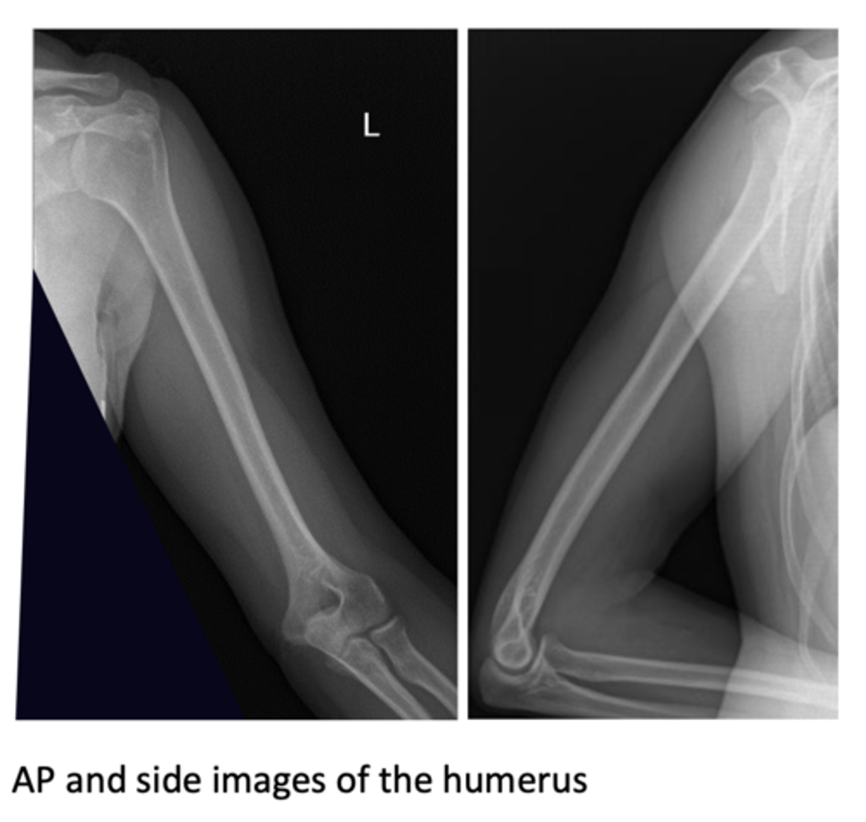 <p>1) AP and lateral: general assessment</p><p>2) axial projection: shoulder, detailed views of the proximal region (head).</p>