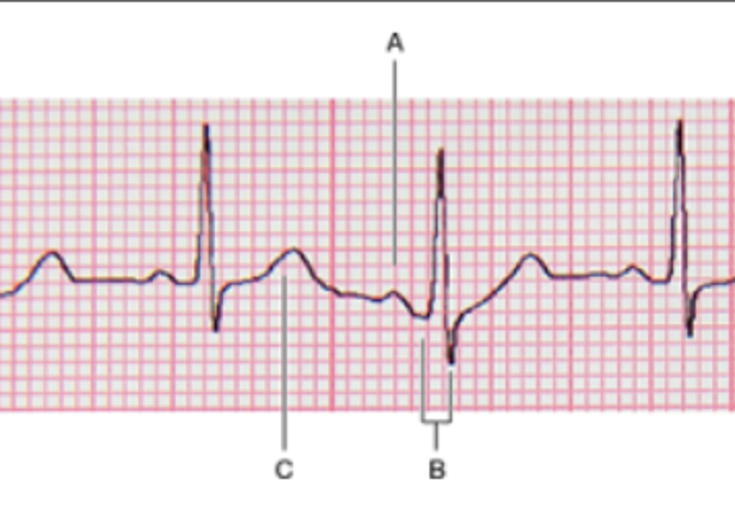 <p>Use the matching question to identify one P wave, QRS complex, and T wave.</p><p>A)</p><p>B)</p><p>C)</p>