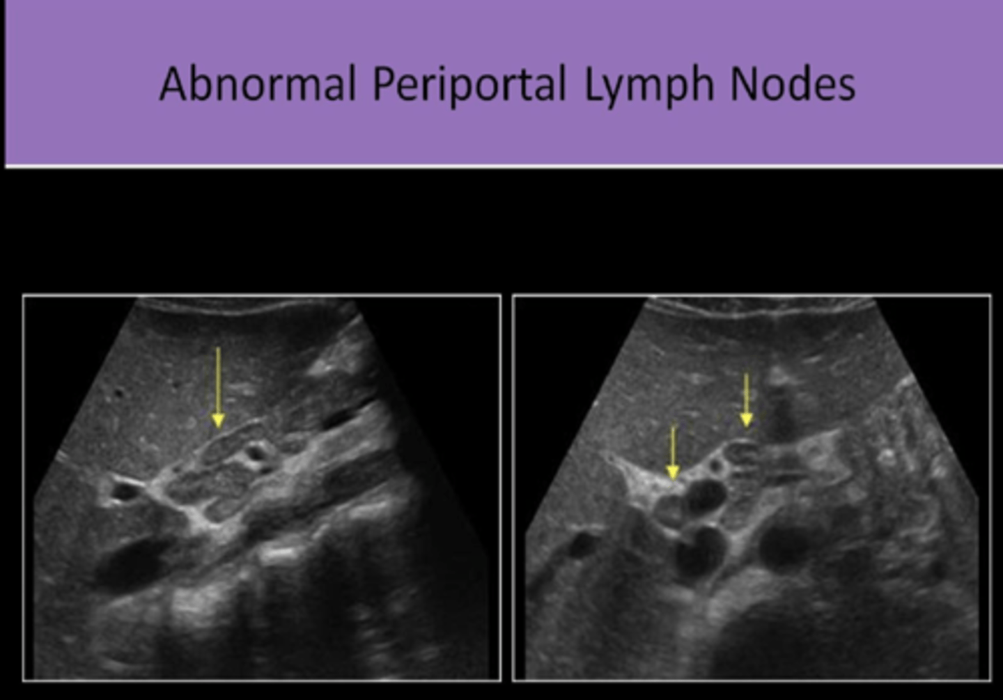 <p>1. para-aortic<br>2. at the splenic hilum<br>3. at the renal hilum<br>4. at the porta hepatis</p>