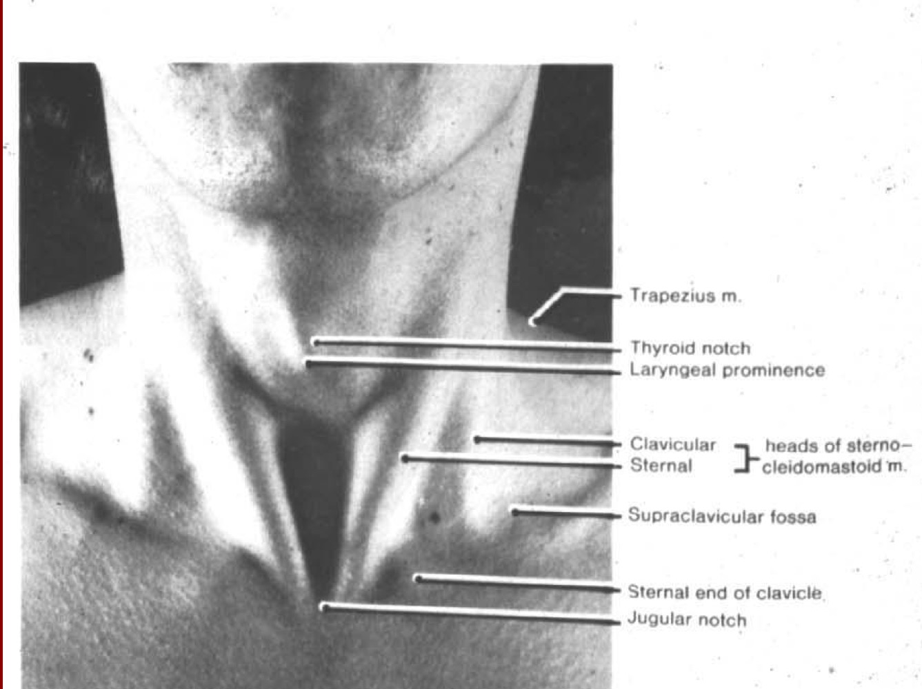 Laryngeal prominence, thyroid notch