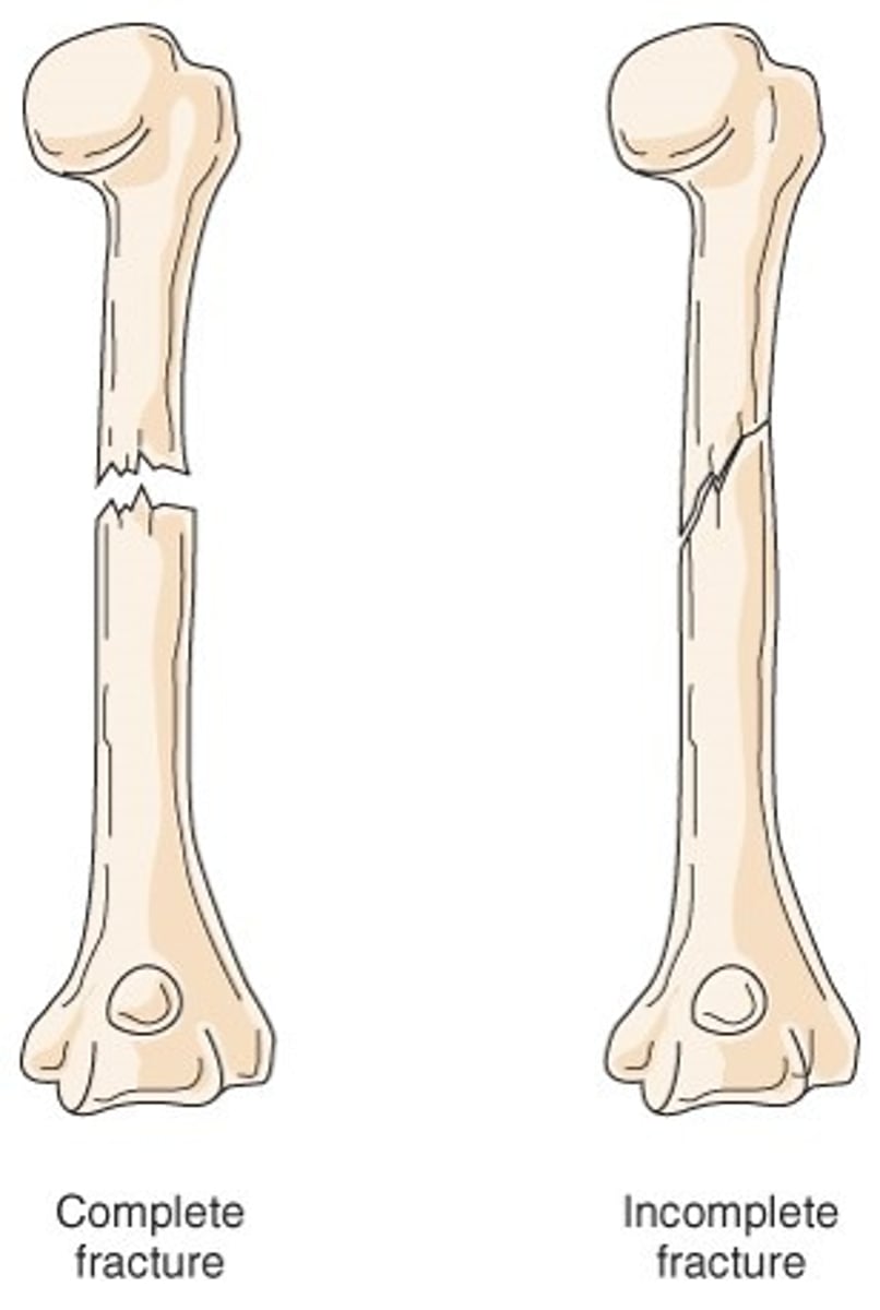 <p>fx doesn't transverse through the entire bone</p>