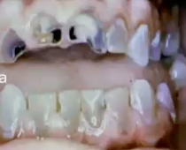 <p>blue/grey teeth with OBLITERATED PULP CHAMBER (shell teeth) </p>
