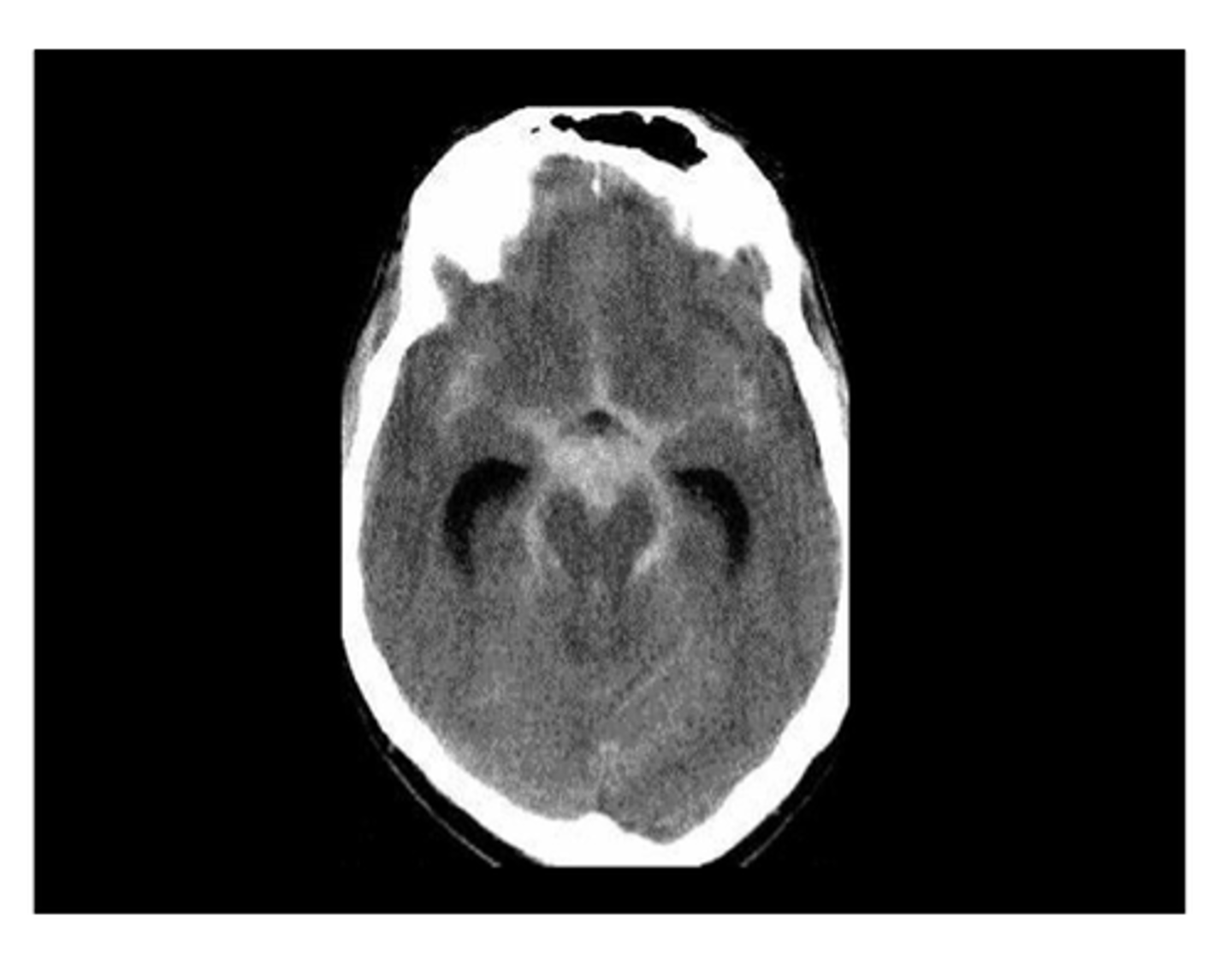 <p>Define Condition:</p><p>Due to rupture of saccular (berry) aneurysms in the Circle of Willis</p><p>-May be due to congenital defect in vessel wall (aneurysm lined by intima without muscular media or elastic layer)</p><p>-A/W Connective Tissue Diseases = autosomal dominant polycystic kidney disease, Ehler-Danlos Syndrome, Marfan syndrome</p>