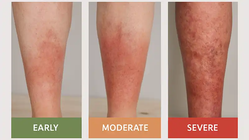 <p>PP/E: chronic venous insufficiency→edema→stasis dermatitis</p><p>CM: hyperpigmentation<br>ulcerations<br>prophx→varicose veins</p><p>PE:<br>heaviness+aching in legs<br>increased→standing<br>decreased→leg elevation</p><p>TX:<br>NP: compression stockings<br>vascular surgery<br>ulcers→chronic tx</p><p>MX: topical triamcinolone BID x 2 weeks on/off</p>