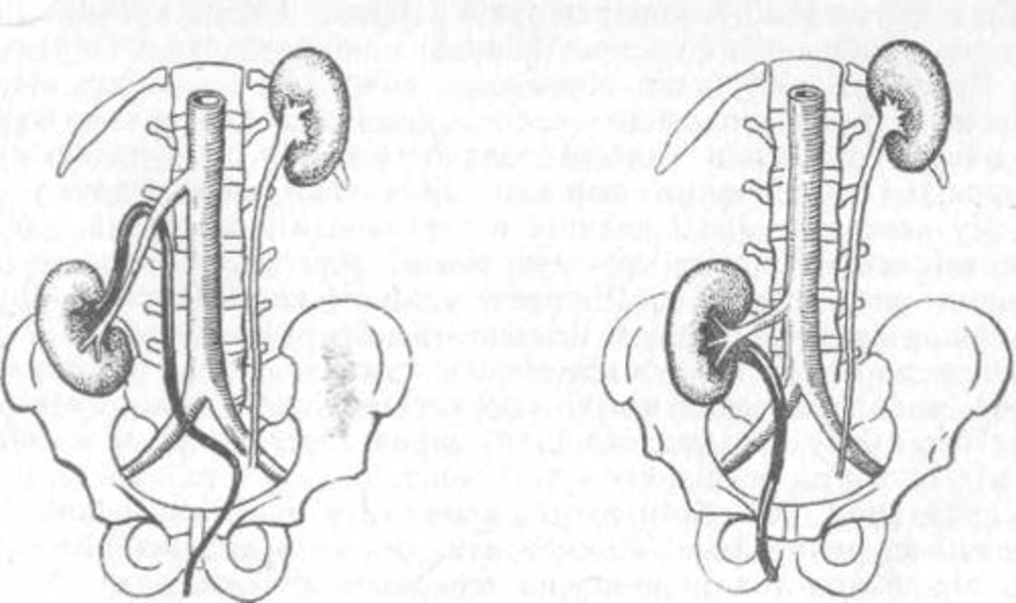 <p>drooping kidney</p>