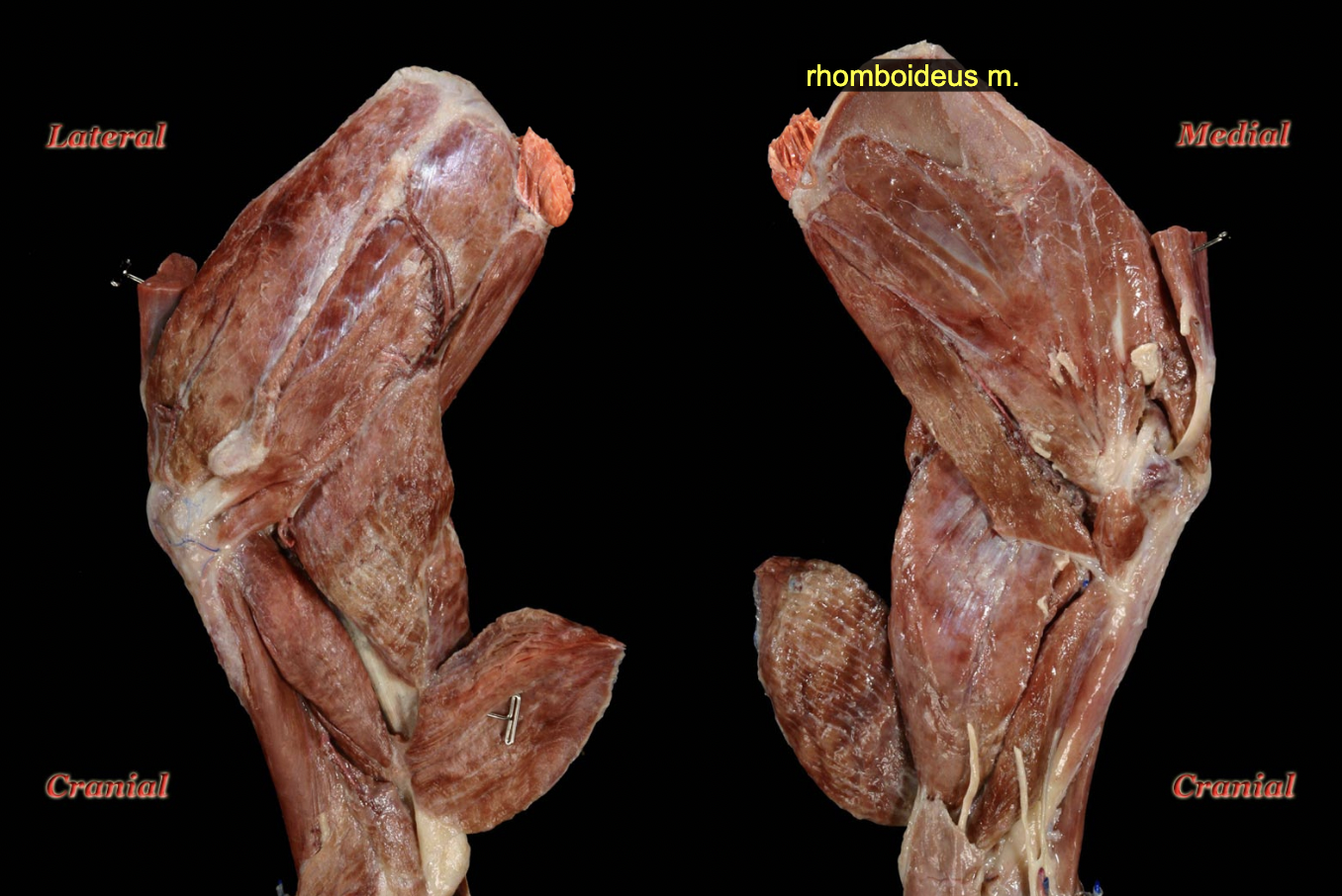 <p><span>O: Nuchal crest of occiput (</span><em>capitis</em><span>), dorsal median raphe of neck and spinous processes of T1-3 (</span><em>cervicis</em><span>), and spinous processes of T4-T6/7 (</span><em>thoracis</em><span>)</span><br><span>I: Dorsal border of scapula</span></p><p><span>N: Cervical and thoracic spinal nerves</span></p><p><span>A: Elevate the limb, draw scapula to body wall</span></p>