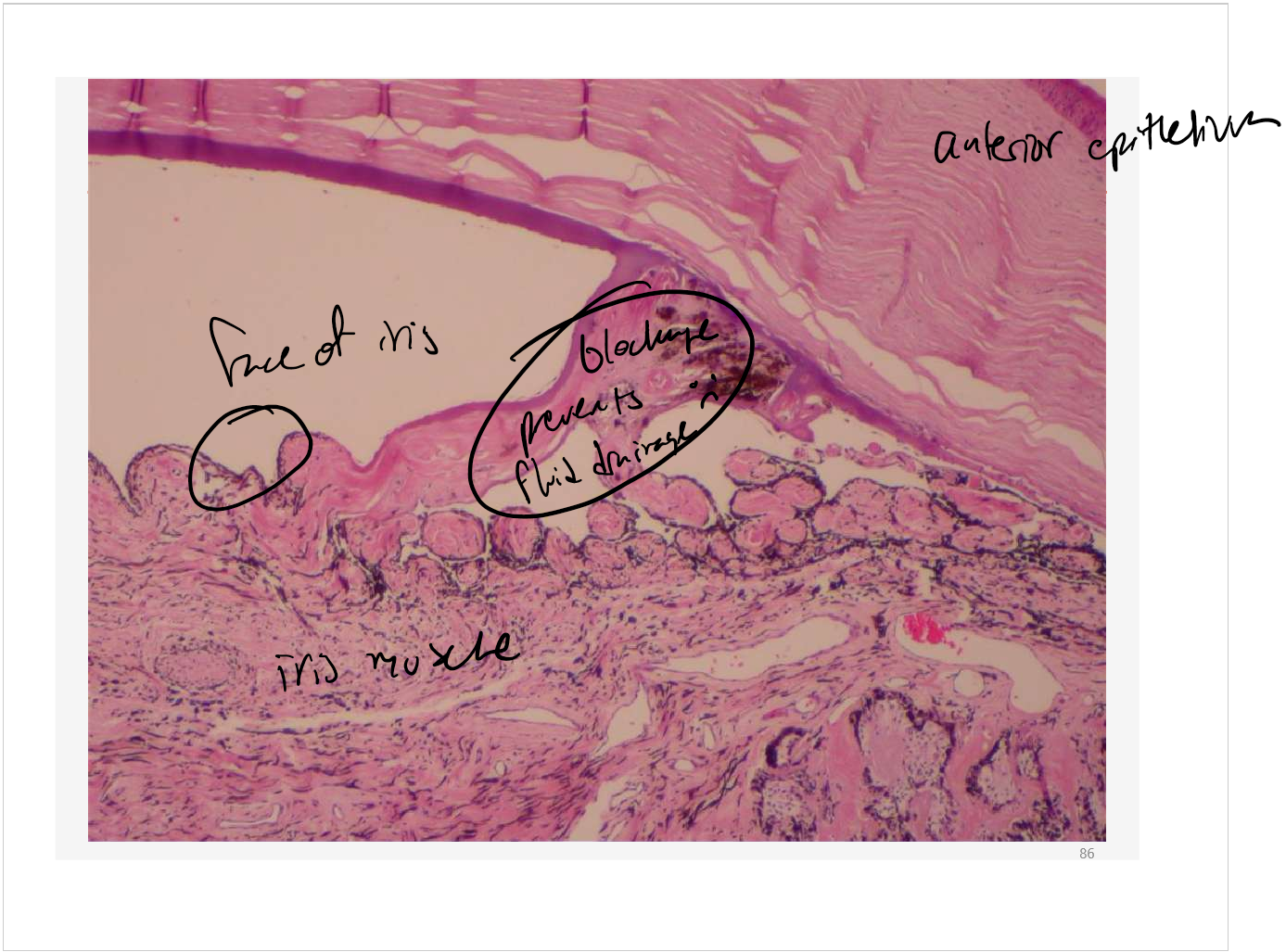 <p>secondary! it is a blockage</p>