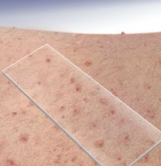 <p>what type of lesion is depicted</p>