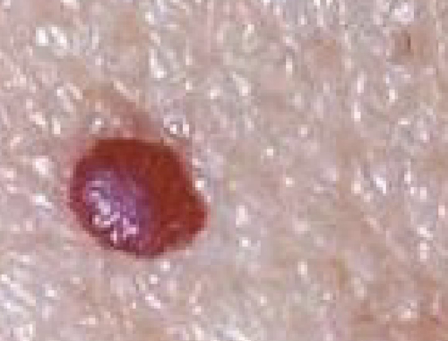 <p>A raised, palpable growth less than 1.0 cm in size</p>