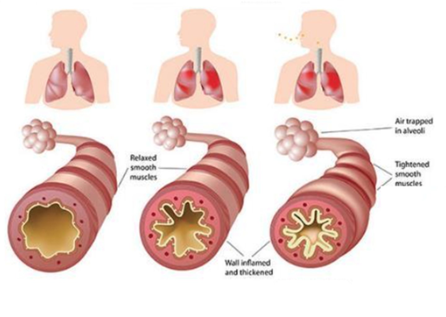<p>Decrease in the size of respiratory airways</p>