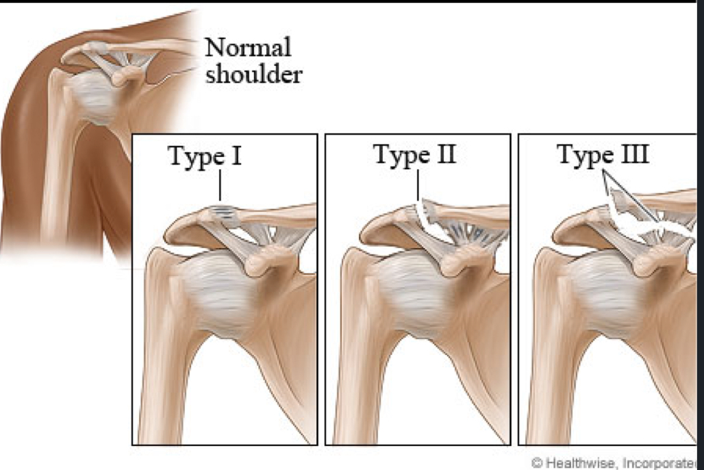 <p>Shoulder Separation</p>