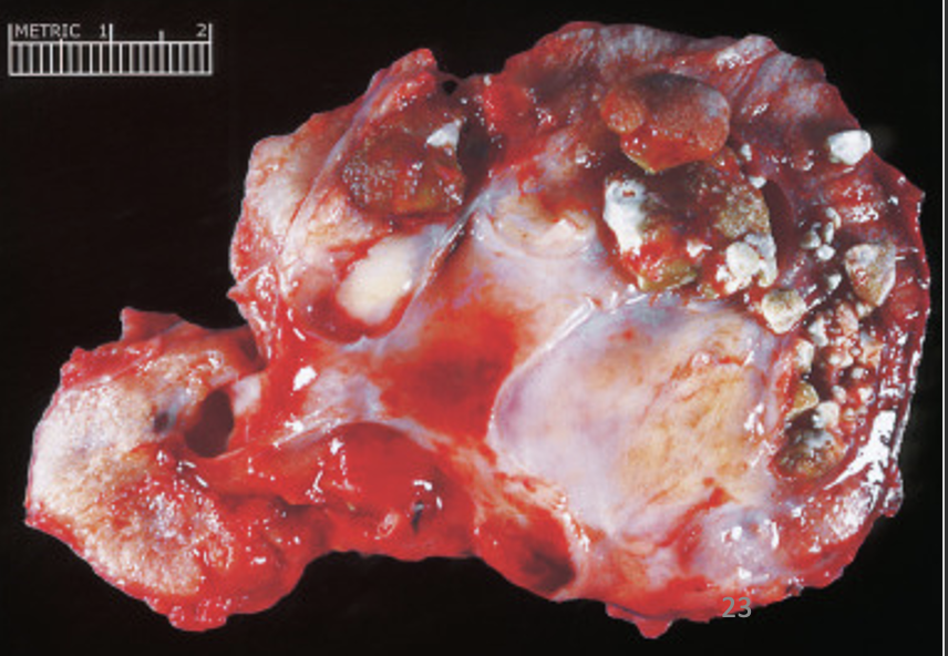 <p>What pathology is indicated by this image?</p>