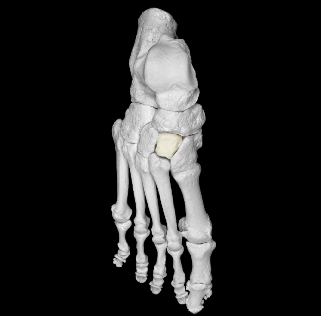 <p>tarsal posterior to metatarsal 2 </p>