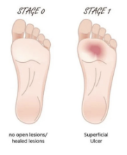 <ul><li><p>Grade 0 </p><ul><li><p>NO open ulceration, but possible existence of bone deformation of hyperkeratosis</p></li></ul></li><li><p>Grade 1</p><ul><li><p>SUPERFICIAL ulceration, but without penetration to deeper tissue</p></li></ul></li></ul><p></p>