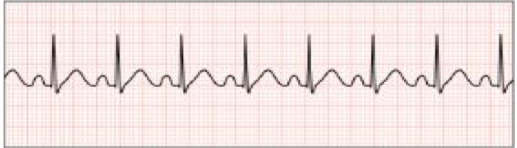 rhythm rate greater than 100 beats per minute

