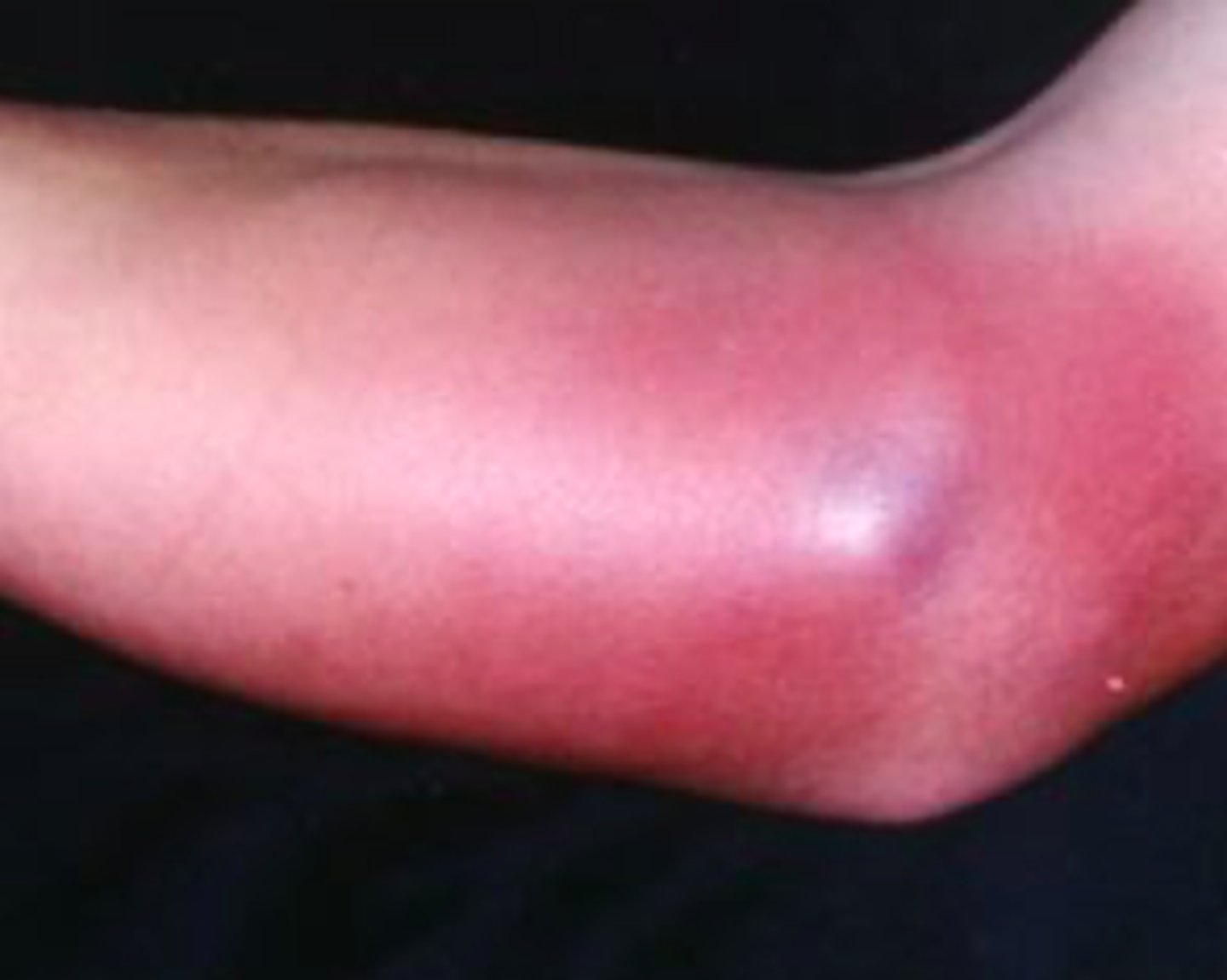 <p>Bacterial Skin Infections:</p><p>- inflammation &amp; infection of the <strong>dermal &amp; subcutaneous tissues (deeper!!!</strong>)</p><p>- caused by <strong>S. aureus and B. hemolytic streptococci in adults</strong> (<strong>HiB</strong> in children)</p><p>- red, hot, tender area of skin originating<strong> at the site of bacterial entry</strong></p><p>- may have a prodrome (malaise, anorexia, fever)</p><p>- will see erythema, <strong>warmth, and edema</strong> of the affected skin</p>