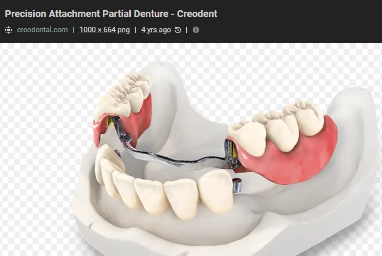 <ul><li><p>dovetail or circular design of component parts</p></li><li><p>supplemental clasp arms on lingual or abutment tooth </p></li></ul><p></p>