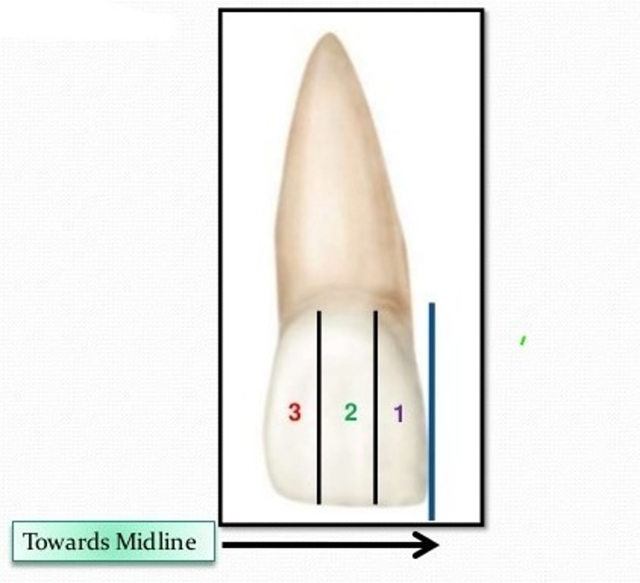 <p>In a facial view of a maxillary central incisor, vertical lines may divide the crown into thirds called 1. mesial, 2. middle, and 3. _______.</p>
