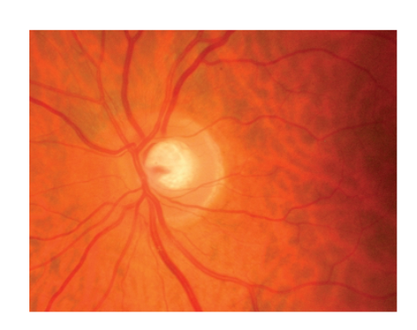 <p>lamina cribosa&nbsp;</p>