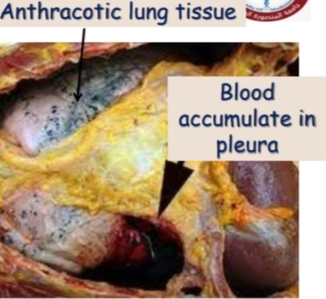 <p>Internal hemorrhage,hemothorax</p><p>hemoperitonium , haemopericardium , hemoarthrosis</p><p>1-Anthracotic lung tissue</p><p>2-Blood accumulate in pleura</p>