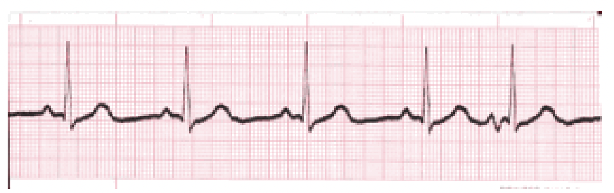 <p>What is the rhythm?</p>