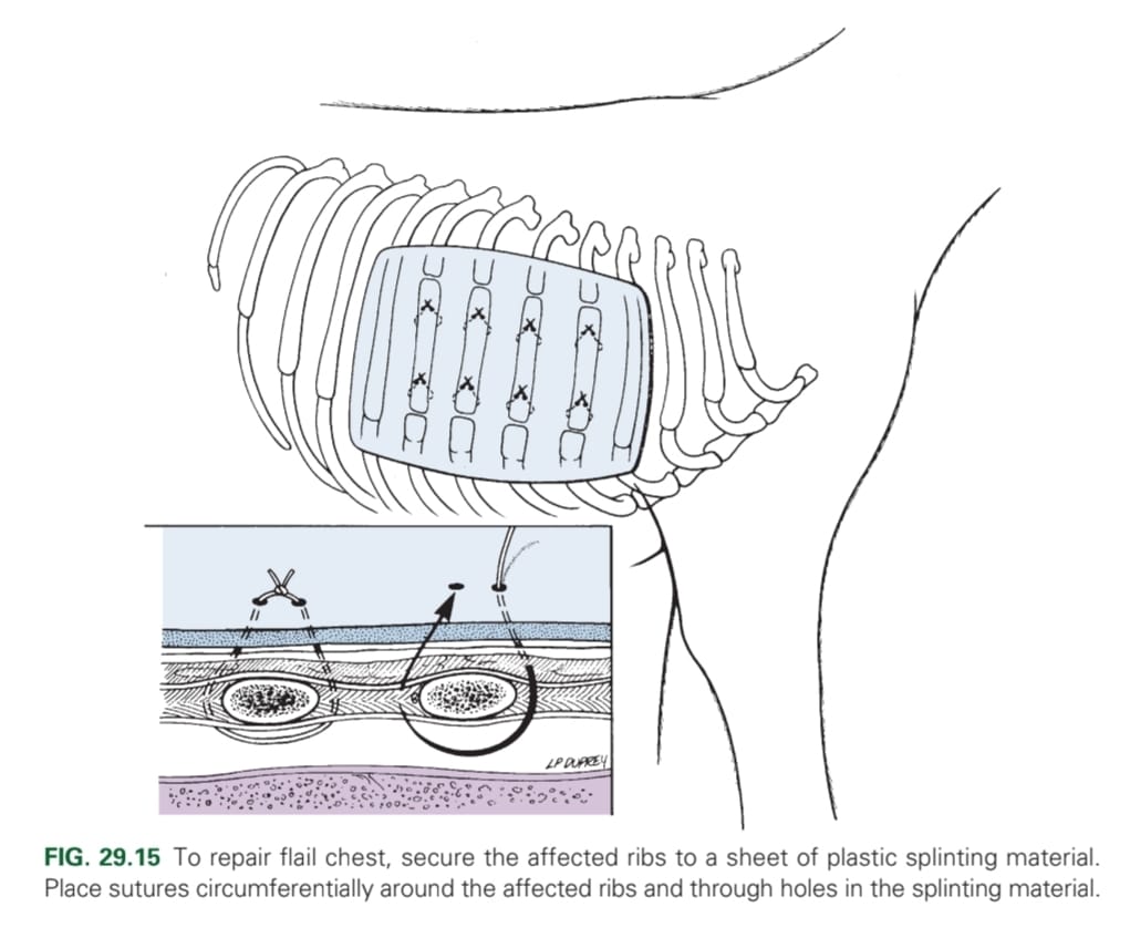 <ol><li><p>Debridement</p></li><li><p>Rib fracture repair (pins, cerclage wire)</p></li><li><p>Flail chest stabilisation (external splints for 4 weeks; fastened with percutaneous sutures and aluminium frame)</p></li></ol><p></p>